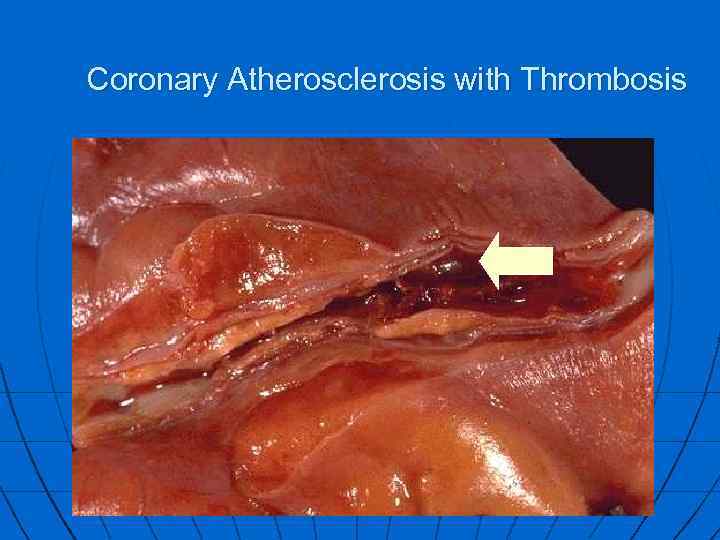 Coronary Atherosclerosis with Thrombosis 