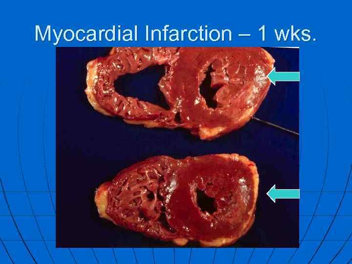 Myocardial Infarction – 1 wks. 