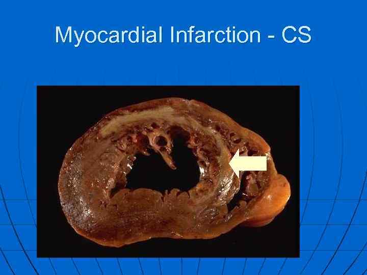 Myocardial Infarction - CS 