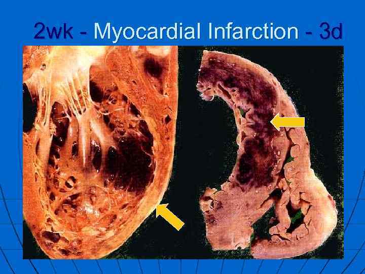 2 wk - Myocardial Infarction - 3 d 