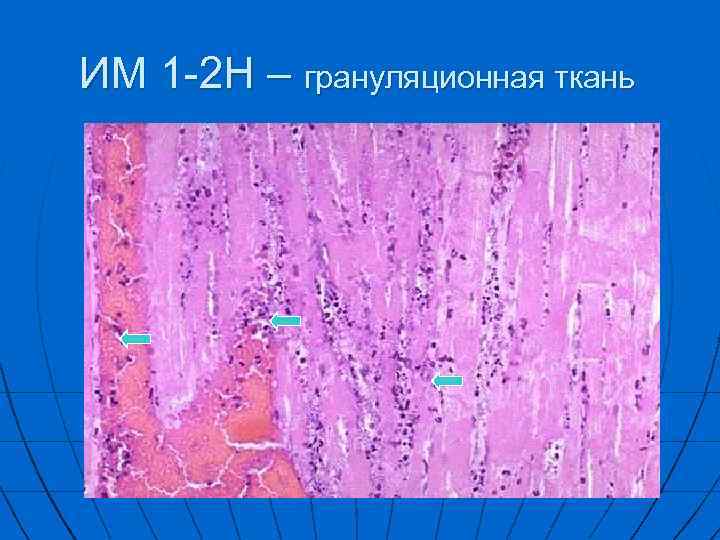ИM 1 -2 Н – грануляционная ткань 