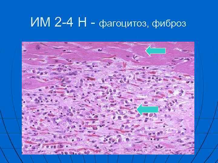 ИM 2 -4 Н - фагоцитоз, фиброз 