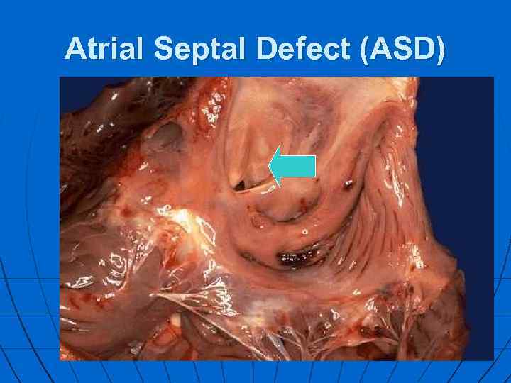 Atrial Septal Defect (ASD) 