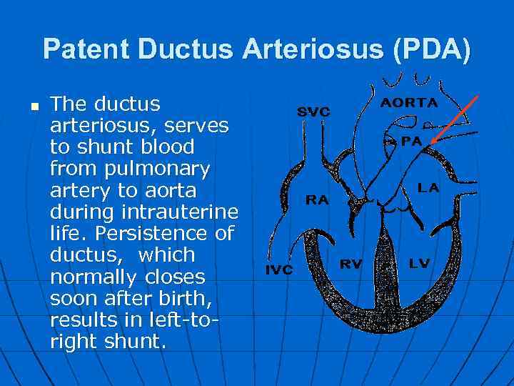 Patent Ductus Arteriosus (PDA) n The ductus arteriosus, serves to shunt blood from pulmonary
