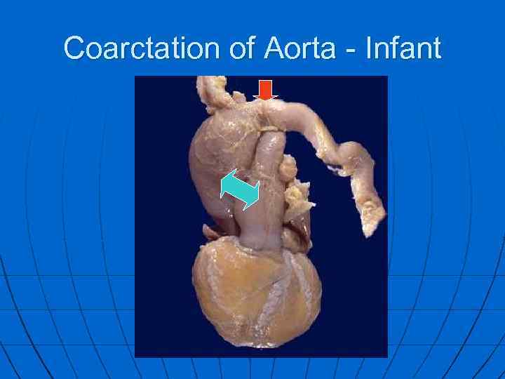 Coarctation of Aorta - Infant 