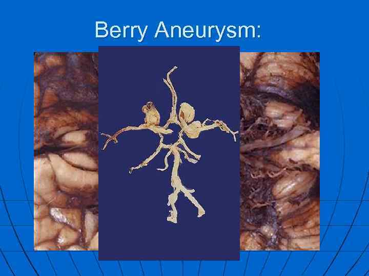 Berry Aneurysm: 