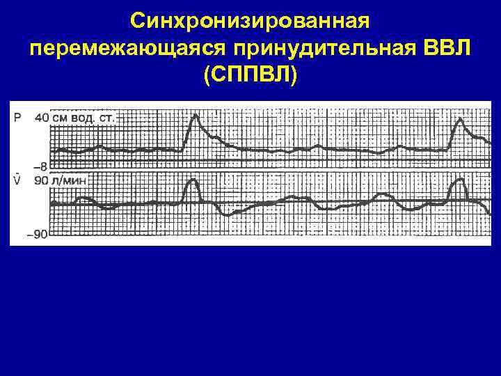 Синхронизированная перемежающаяся принудительная ВВЛ (СППВЛ) 