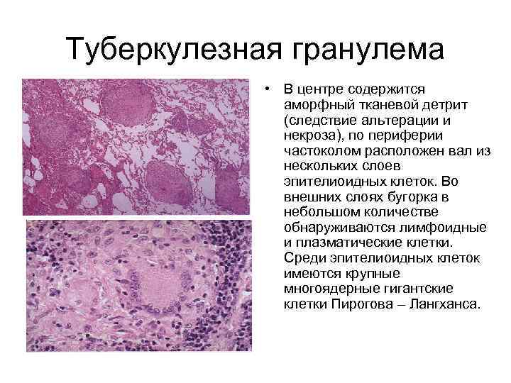 Туберкулезная гранулема • В центре содержится аморфный тканевой детрит (следствие альтерации и некроза), по