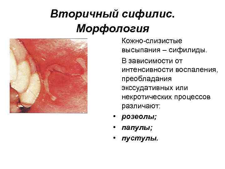 Вторичный сифилис. Морфология Кожно-слизистые высыпания – сифилиды. В зависимости от интенсивности воспаления, преобладания экссудативных