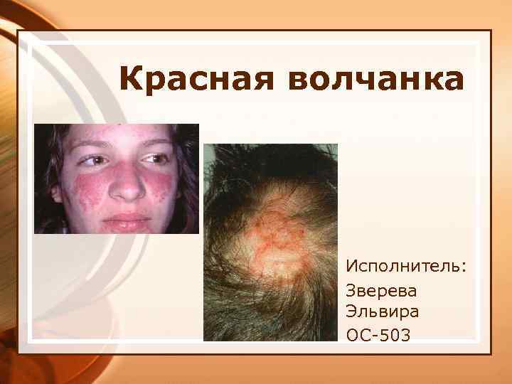 Красная волчанка Исполнитель: Зверева Эльвира ОС-503 