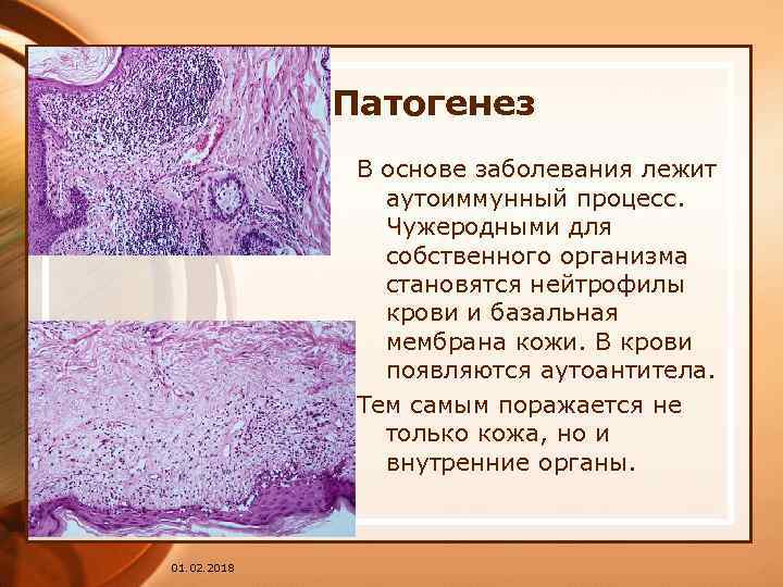 Патогенез В основе заболевания лежит аутоиммунный процесс. Чужеродными для собственного организма становятся нейтрофилы крови