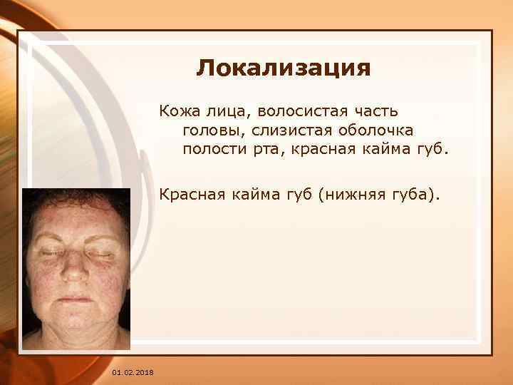 Локализация Кожа лица, волосистая часть головы, слизистая оболочка полости рта, красная кайма губ. Красная