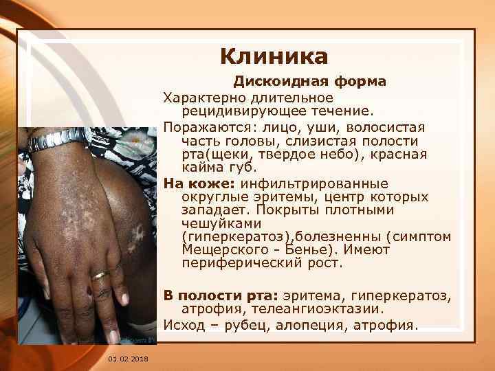 Клиника Дискоидная форма Характерно длительное рецидивирующее течение. Поражаются: лицо, уши, волосистая часть головы, слизистая