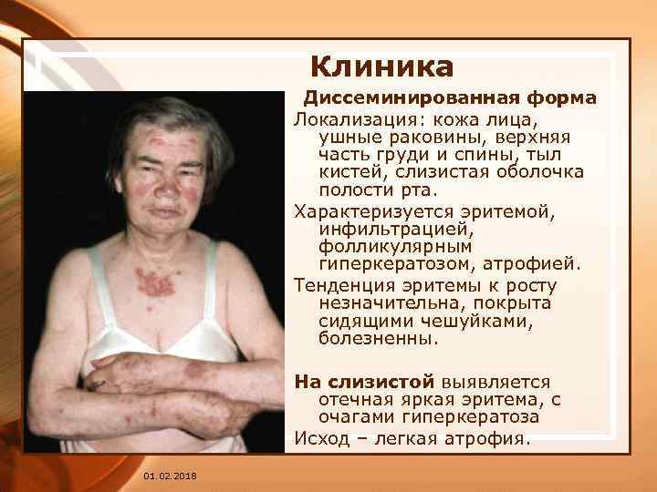 Клиника Диссеминированная форма Локализация: кожа лица, ушные раковины, верхняя часть груди и спины, тыл