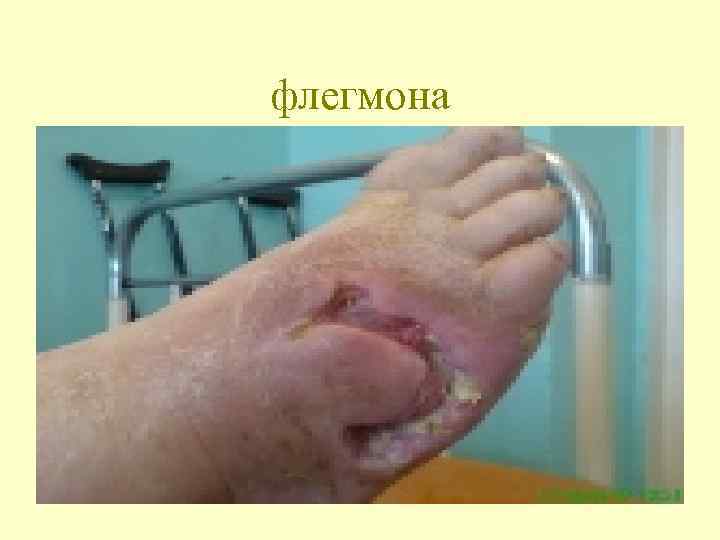 флегмона 