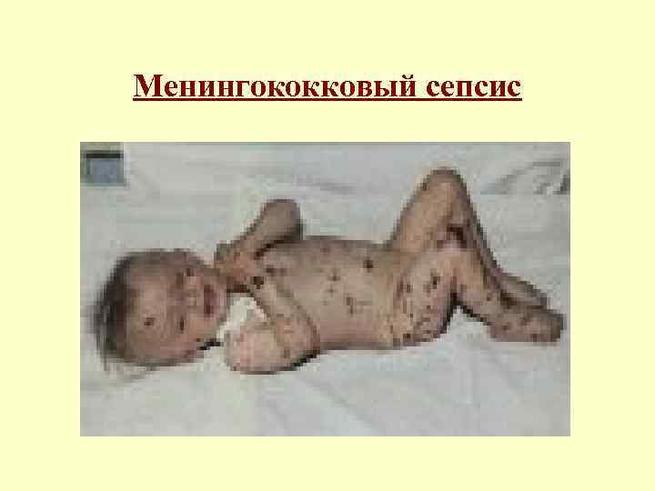 Менингококковый сепсис 