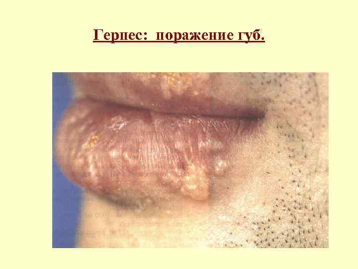 Герпес: поражение губ. 