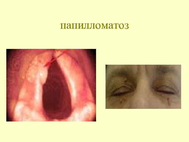 папилломатоз 
