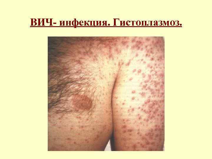 ВИЧ- инфекция. Гистоплазмоз. 