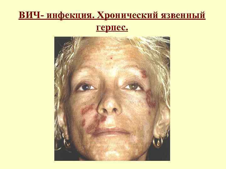 ВИЧ- инфекция. Хронический язвенный герпес. 
