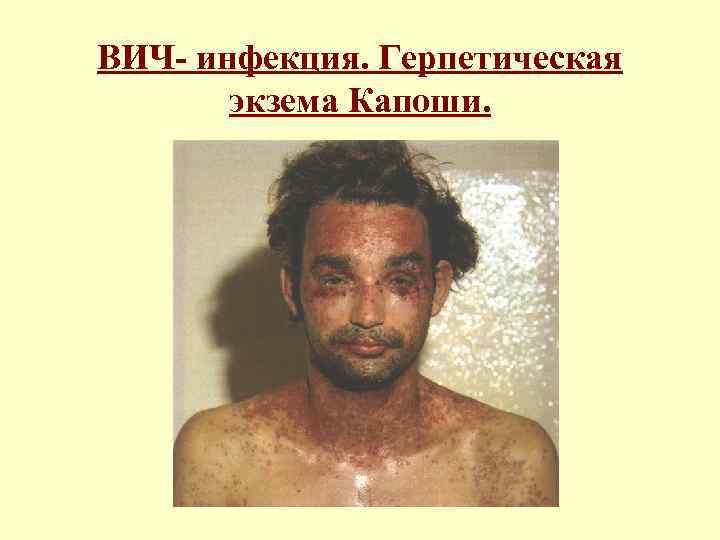 ВИЧ- инфекция. Герпетическая экзема Капоши. 