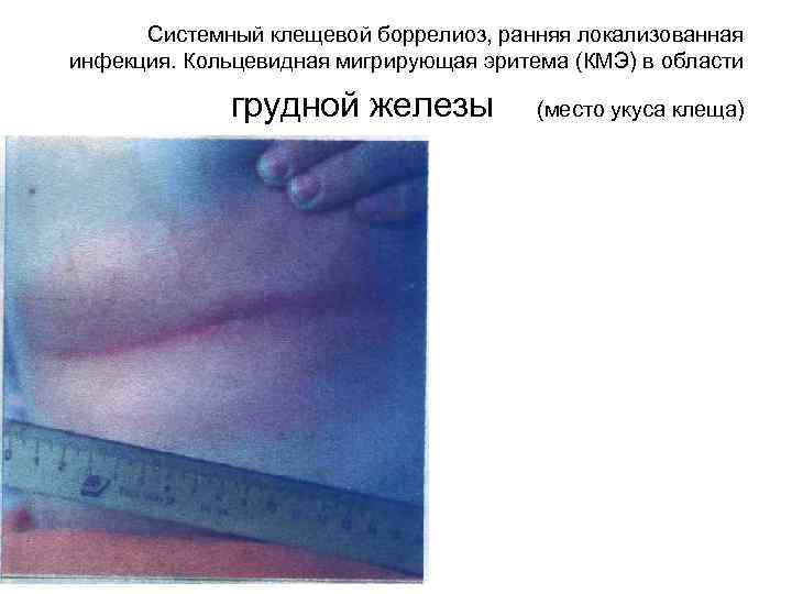 Системный клещевой боррелиоз, ранняя локализованная инфекция. Кольцевидная мигрирующая эритема (КМЭ) в области грудной железы