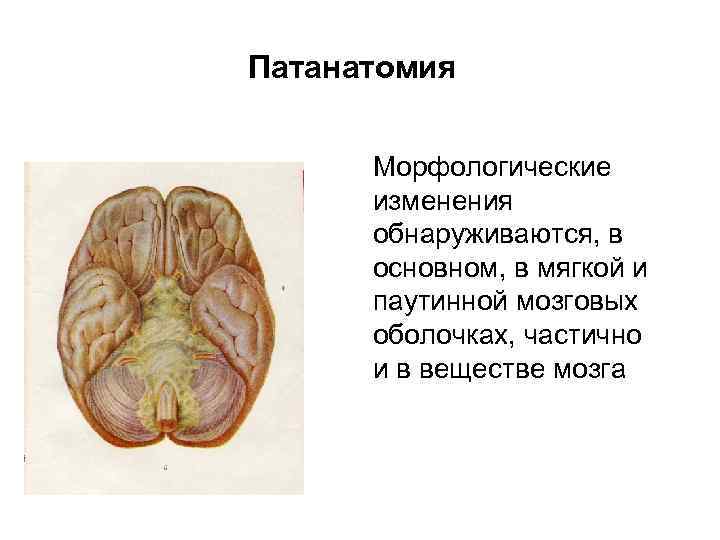 Патанатомия Морфологические изменения обнаруживаются, в основном, в мягкой и паутинной мозговых оболочках, частично и