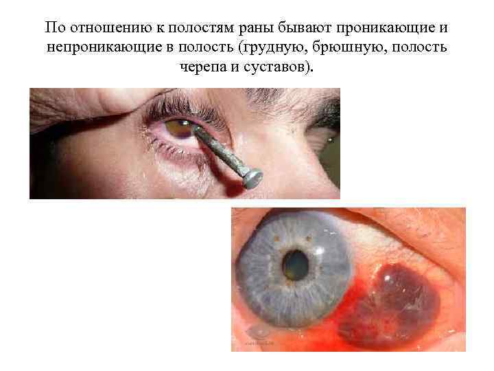 По отношению к полостям раны бывают проникающие и непроникающие в полость (грудную, брюшную, полость