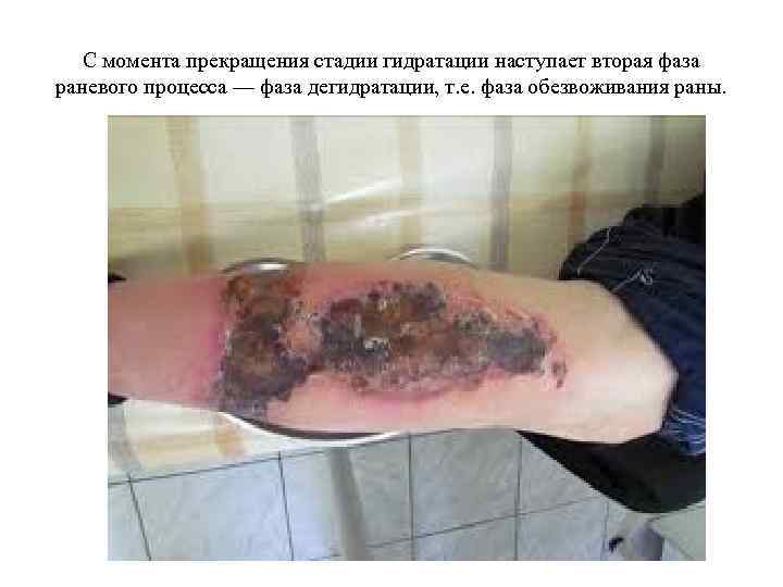 С момента прекращения стадии гидратации наступает вторая фаза раневого процесса — фаза дегидратации, т.