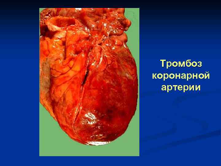 Тромбоз коронарной артерии 