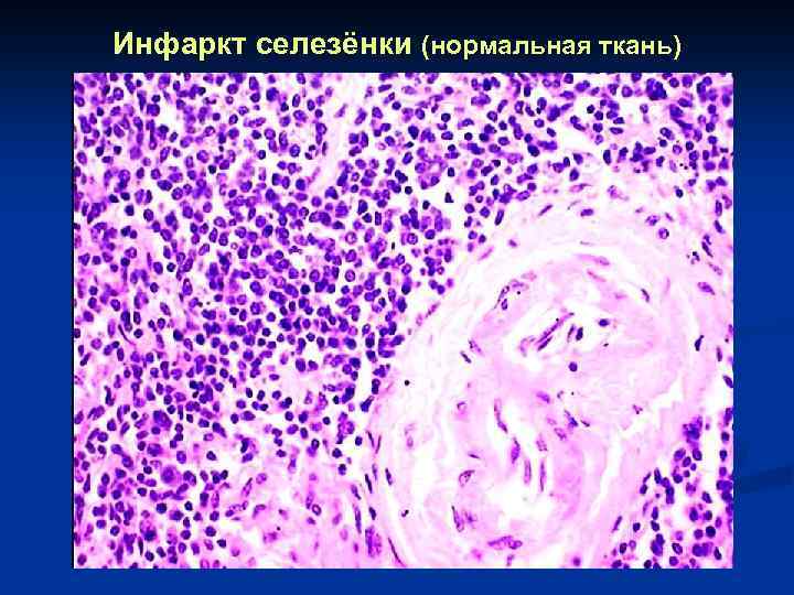 Инфаркт селезёнки (нормальная ткань) 