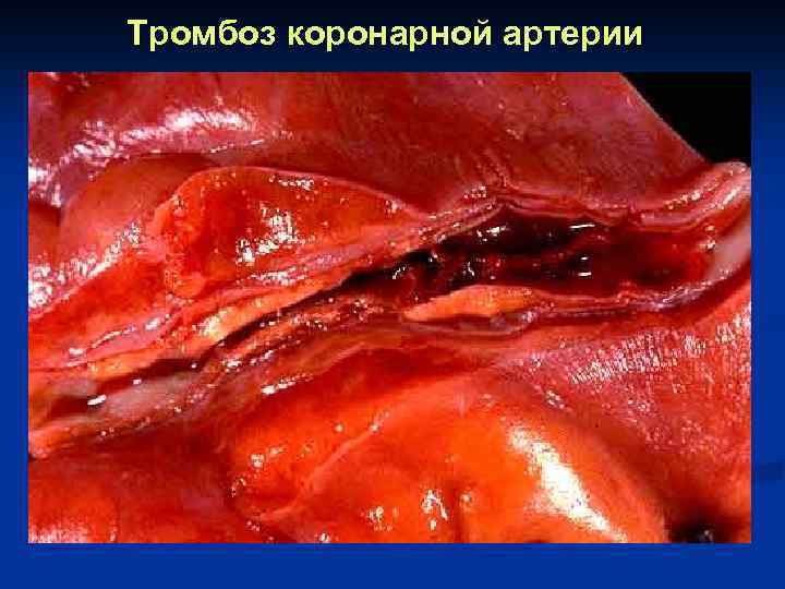 Тромбоз коронарной артерии 