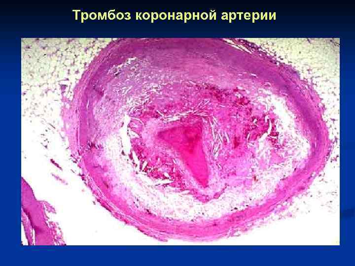 Тромбоз коронарной артерии 