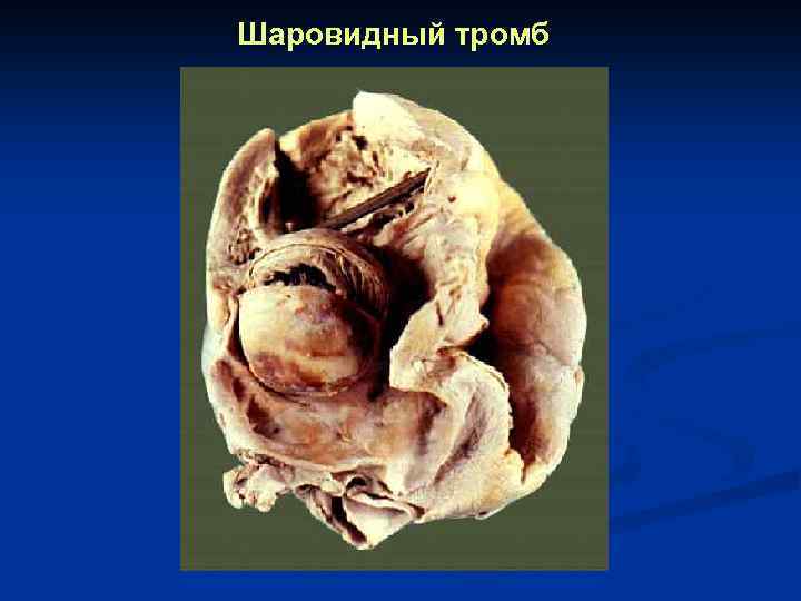 Шаровидный тромб 