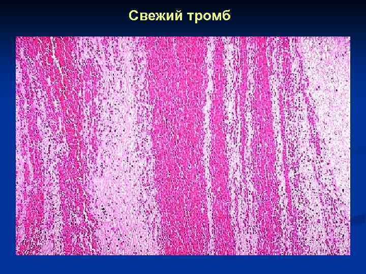 Свежий тромб 