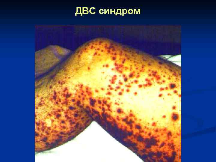 ДВС синдром 