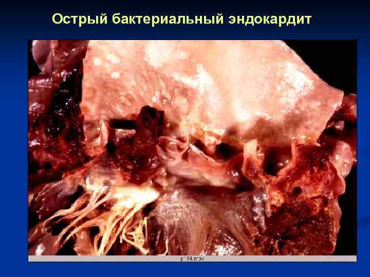 Острый бактериальный эндокардит 