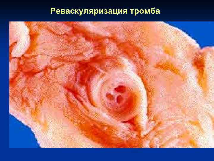 Реваскуляризация тромба 