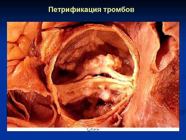 Петрификация тромбов 