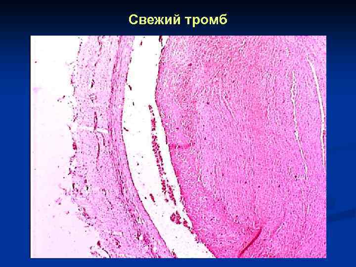 Свежий тромб 