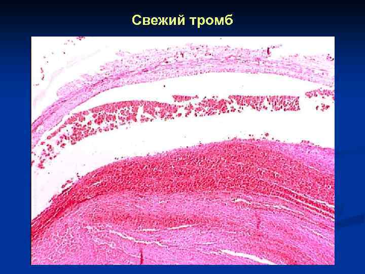 Строение тромба. Обтурирующий тромб гистология. Красный обтурирующий тромб микропрепарат. Свежий тромб микропрепарат. Свежий тромб артерии микропрепарат.