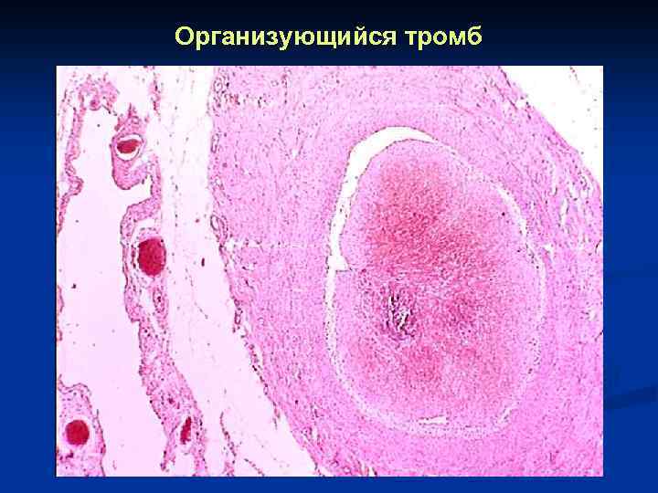 Тромб микропрепарат. Организованный тромб в Вене микропрепарат. Красный обтурирующий тромб микропрепарат. Септический тромбофлебит микропрепарат. Организованный тромб микропрепарат.