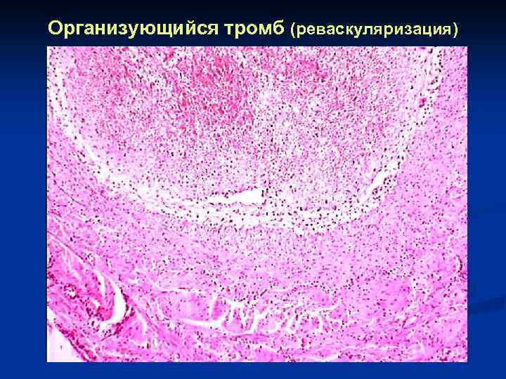 Организующийся тромб (реваскуляризация) 