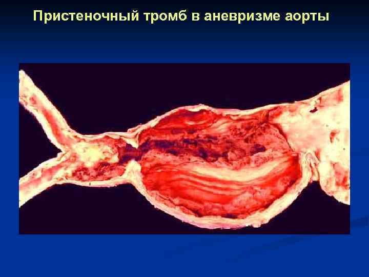 Пристеночный тромб в аневризме аорты 