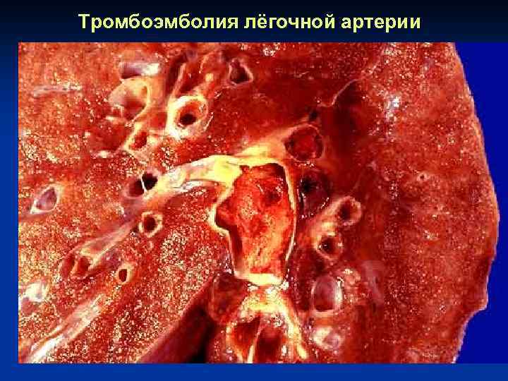 Тромбоэмболия лёгочной артерии 