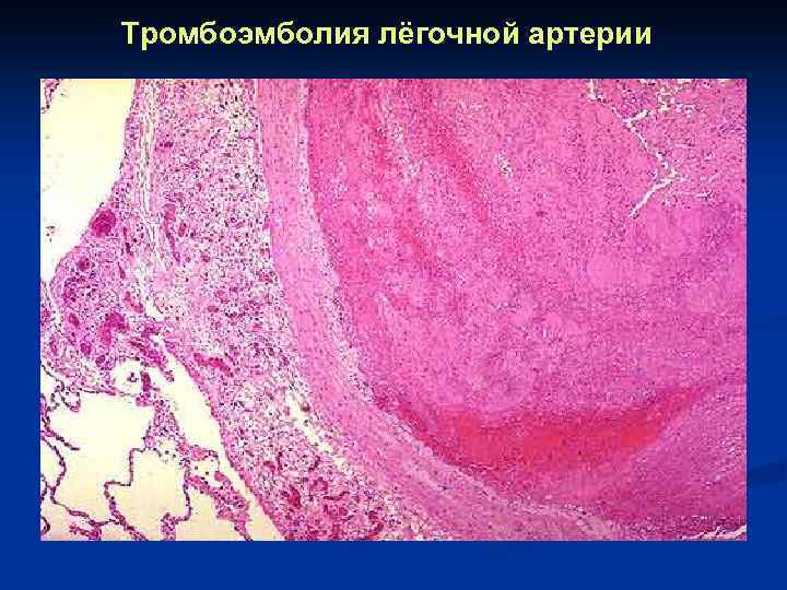 Тромбоэмболия лёгочной артерии 