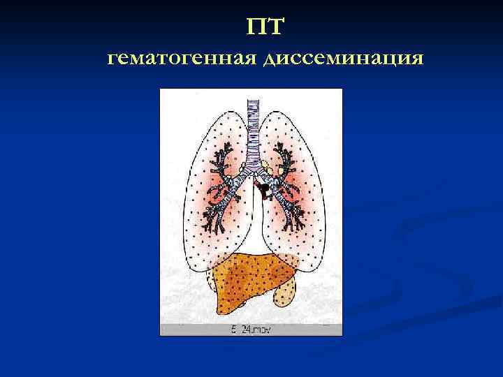 ПТ гематогенная диссеминация 