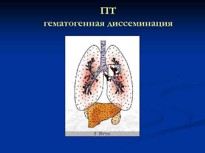 ПТ гематогенная диссеминация 