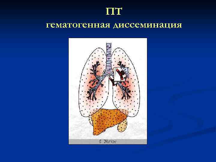 ПТ гематогенная диссеминация 