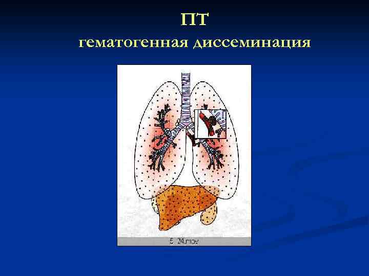 ПТ гематогенная диссеминация 